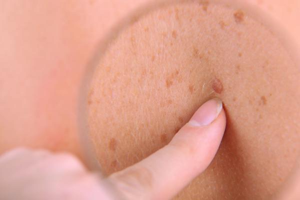 آنالیز سرطان پوست