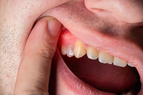 پژوهشگران ژاپنی و دارویی برای رشد دوباره دندان ها در انسان!